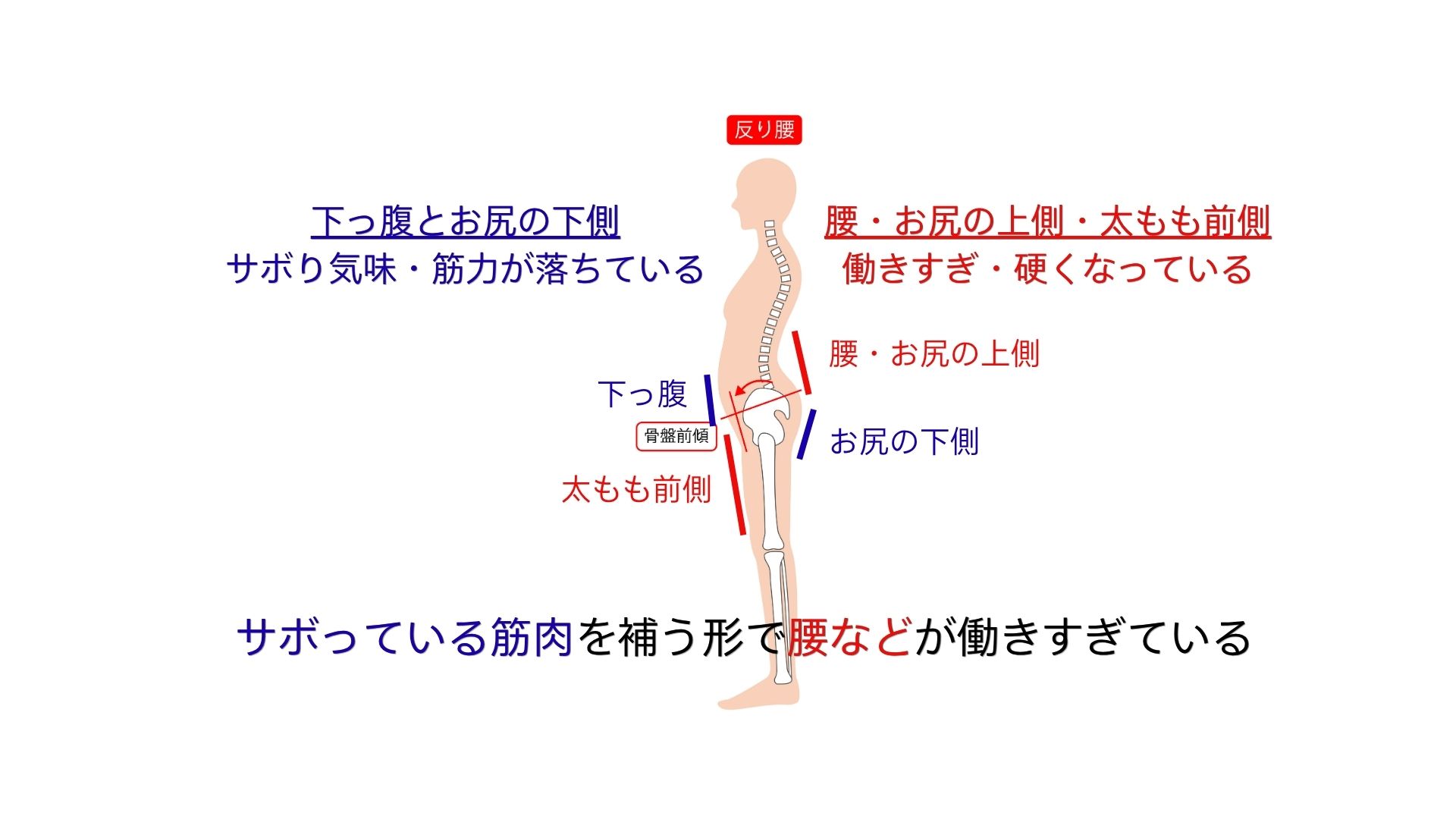 反り腰