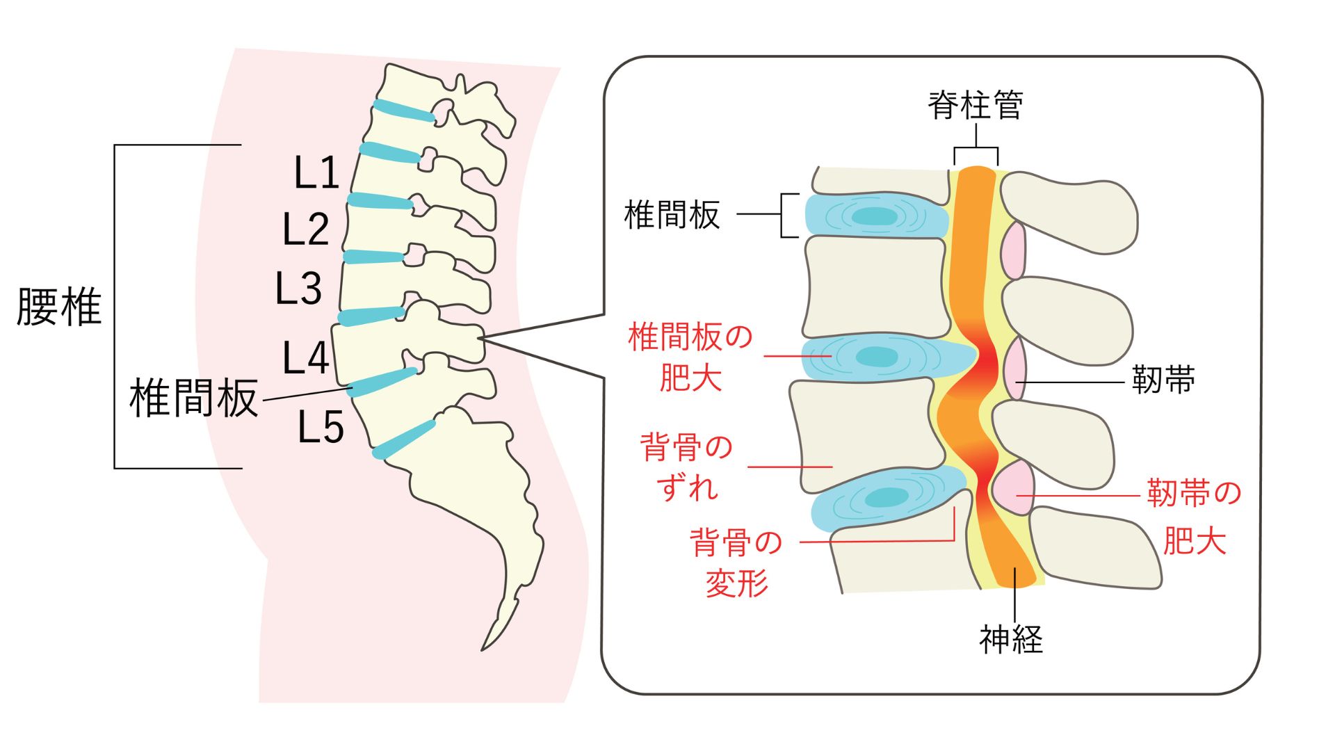 脊柱管狭窄症
